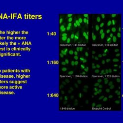 Ana autoimmune combined developing titre predict clinical conditions features children high figure